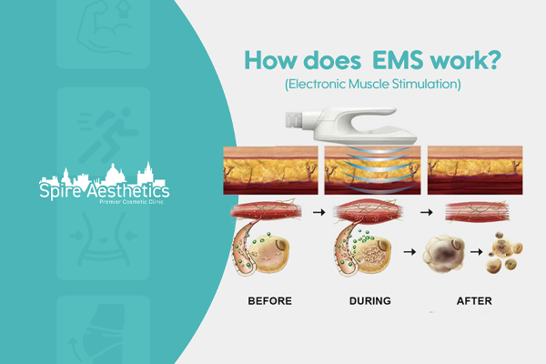 EMS treatment for post pregnancy weight loss treatment Chinnor