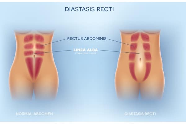 What Non-Surgical Options Are Available for Diastasis Recti Chinnor?