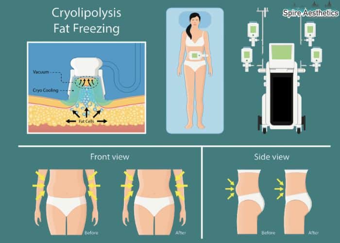 Image of diet and fat freezing combined for best results for Spire Aesthetics Chinnor