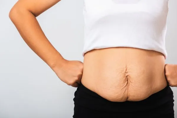 Image of a woman's stomach after weight loss with sagging skin following a gastric band Chinnor