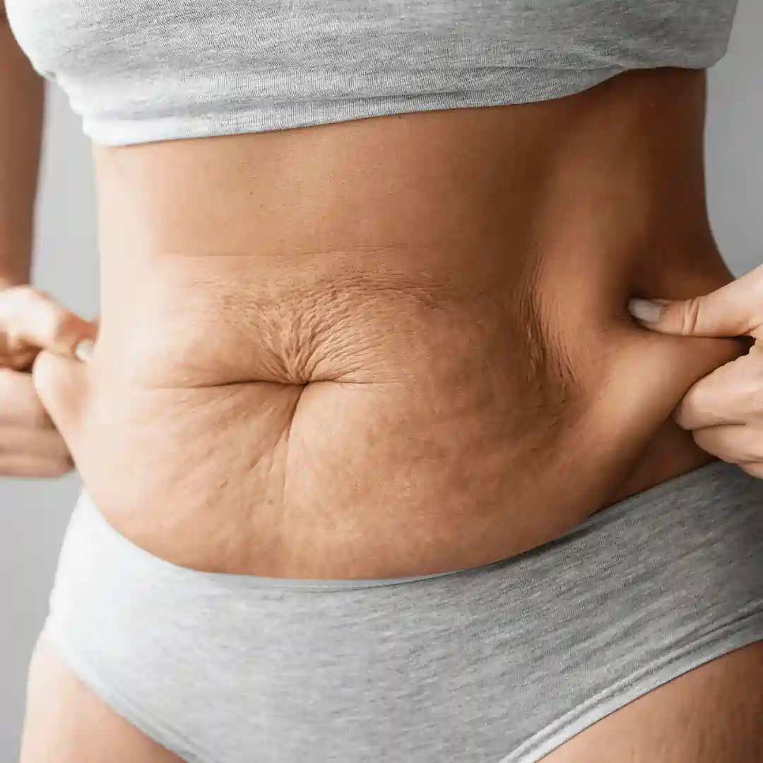 Is It Normal to Have Loose Skin After Pregnancy Chinnor?