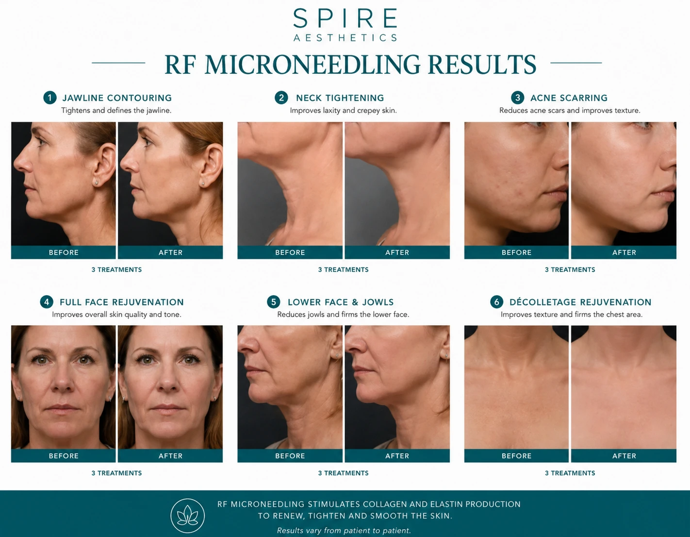 RF Microneedling Skin tightening Chinnor results