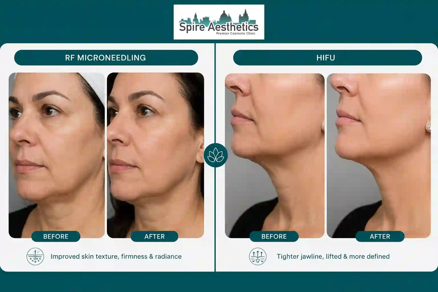 Can RF Microneedling and HIFU Be Combined Chinnor?