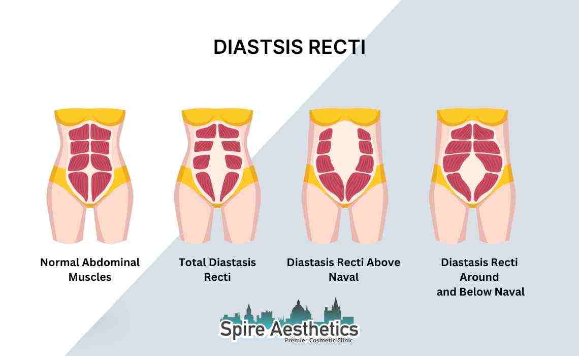 Is Non-Surgical Diastasis Recti Treatment Right for You? Common Concerns Answered Chinnor